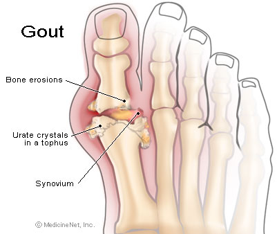 โรคเกาท์ Gout