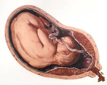 ภาพทารกที่อยู่ในภาวะรกเกาะต่ำในครรภ์