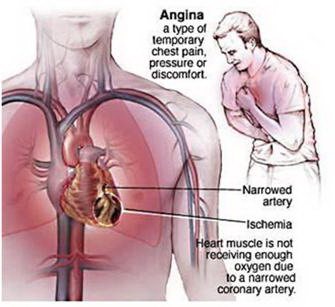 อาการเจ็บหน้าอก หลอดเลือดหัวใจตีบ โรคหัวใจขาดเลือด