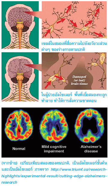 สาเหตุของโรคอัลไซเมอร์ โรคสมองเสื่อม การไม่ทานอาหารเช้า