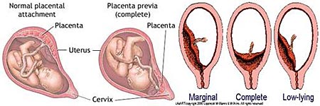 ภาวะรกเกาะต่ำ placenta previa